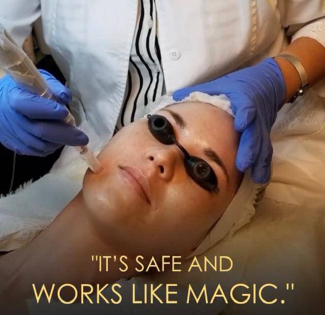 Microneedling Scar Removal