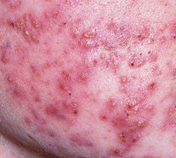 What is Cystic Acne?