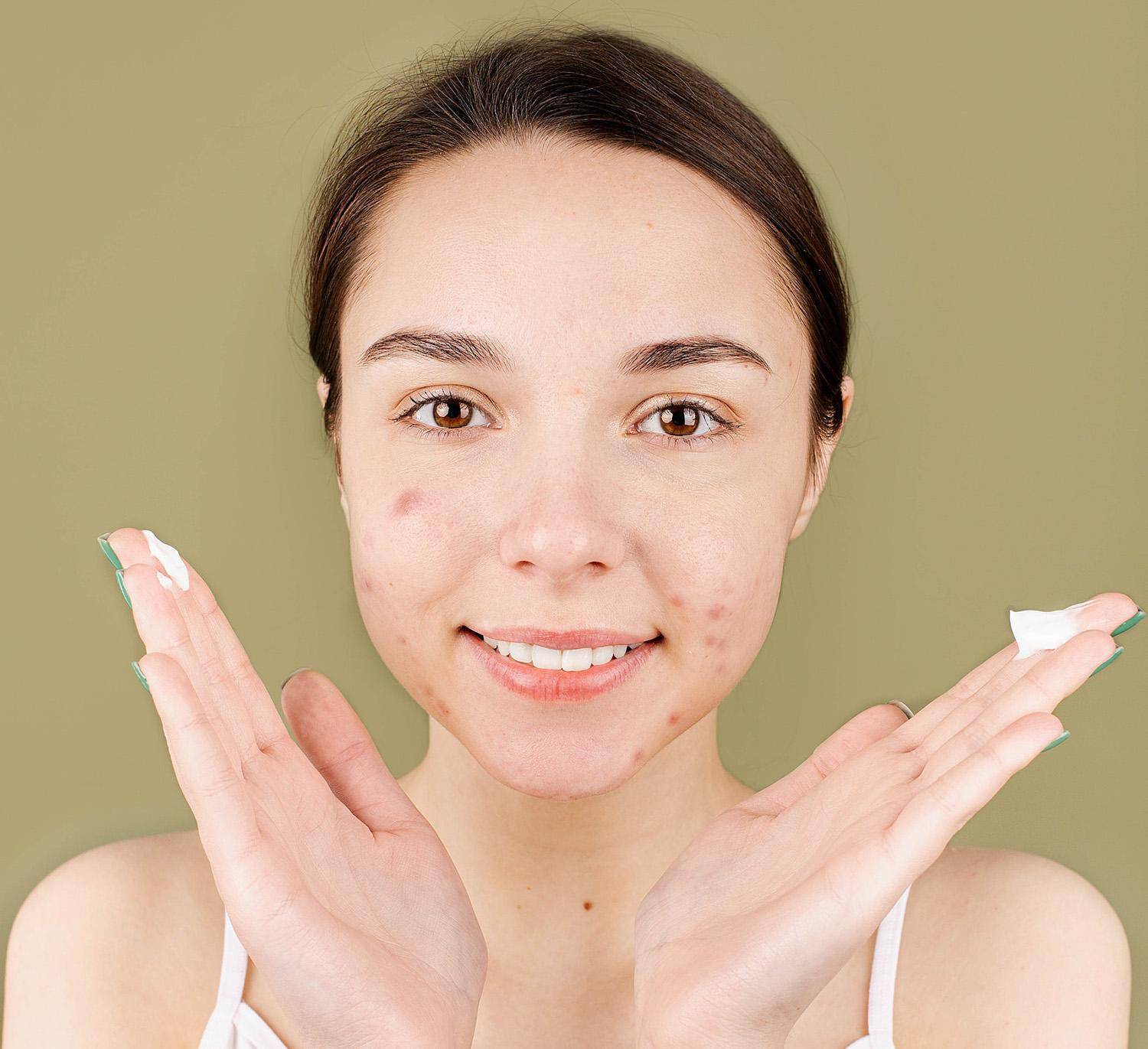 how to treat acne scars how to get rid of acne scars