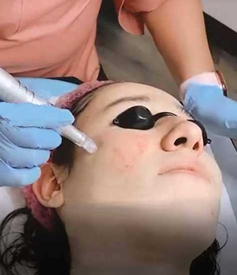 Acne Self Treatments versus Acne Specialists