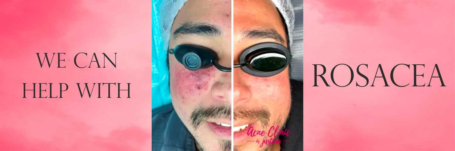 what-is-rosacea What is Rosacea